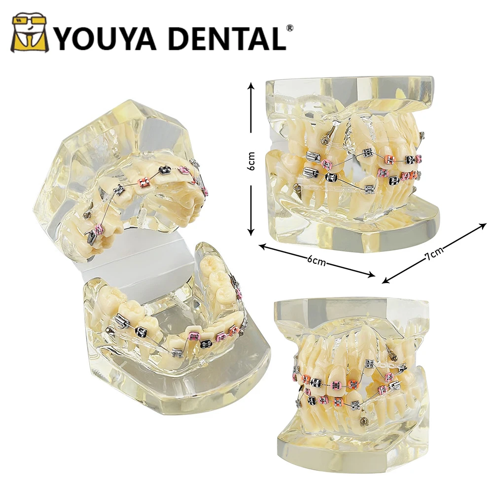 Orthodontic Model Ortho Metal Bracket Model For Dental Clinics Technician Student Dentist Doctor-patient Communication Tool