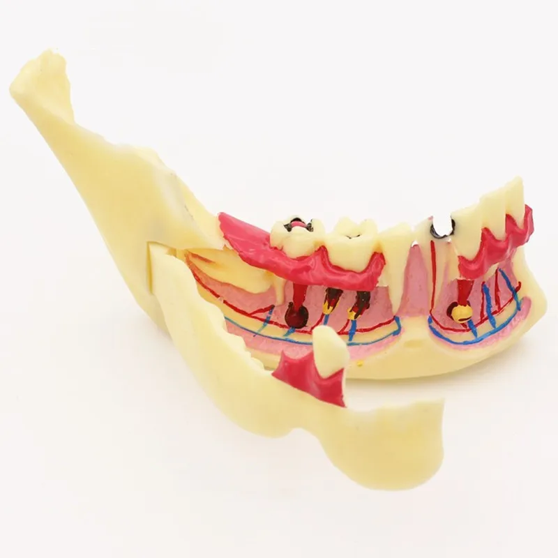 Dental Endodontic Treatment Model Mandible Tissue Anatomical Model Anatomy of Gums Dentistry Study Oral Care Teach Teeth Model