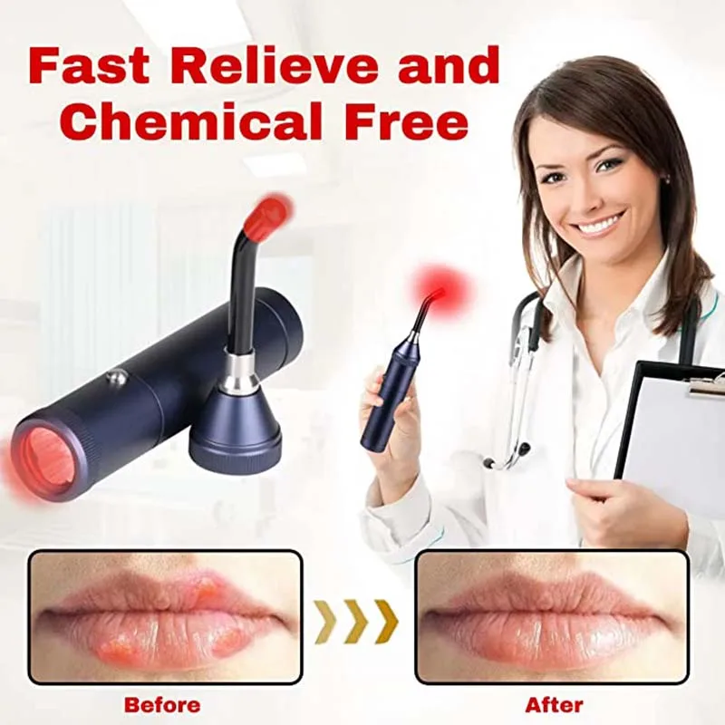 Body Pain Relief Equipment Laser Treatment Of Oral Ulcers And Cold Sores Three-In-One Cold Sore Treatment Device