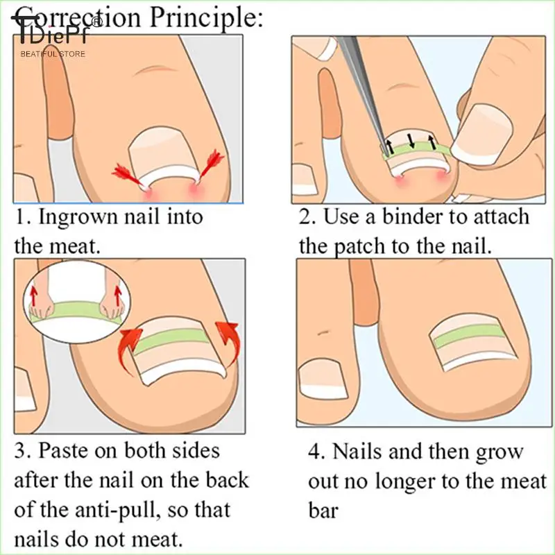 10 pc/box ferramenta de correção de unhas encravadas toe tratamento de unhas adesivo de remendo elástico alisamento clipe cinta pedicure ferramenta