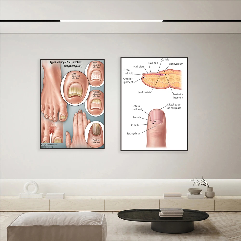 Nail structure, subungual infection and pseudoarthrosis, nail fungus infection educational printable, nail health poster