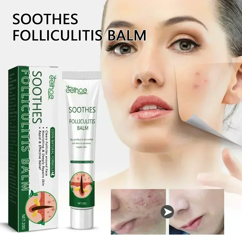 Folliculitis Psoriasis Cream Treat Inflammation Cysts Papules Acne Moisturizing Relief Dry Skin Anti Itching Antibacterial Cream