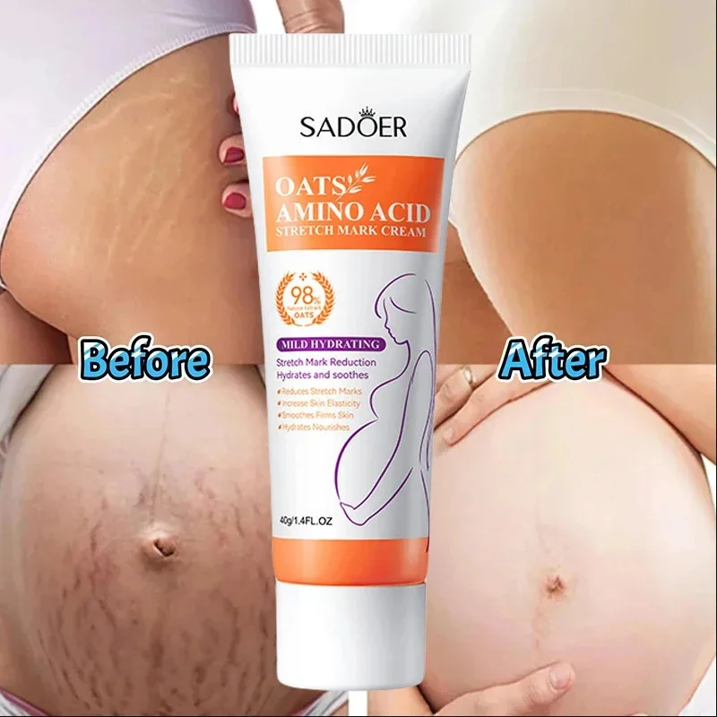 Amino Acid Stretch Mark Cream Reduces Stretch Marks Scar Removal lncrease Skin Elasticity Smoothes Firms Skin Hydrates Nourishes