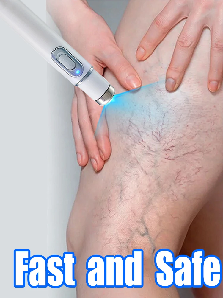 Hot sale Nano Laser Leg Vein