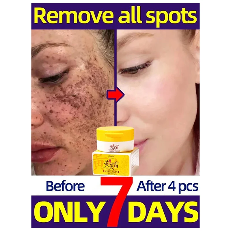 Astragalus Whitening Freckle Cream Face Remove Dark Spots Melasma Lighten Melanin Acne Scars Anti-aging Brighten White Skin Care