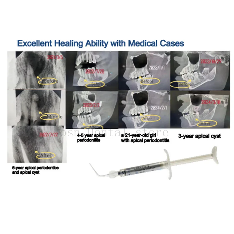 BEIKANG 2g/pcs ABIS™️PASTE Oral ABIS Paste Abscess Remedy Antibacterial Gel PasteAibaosu Antibacterial Agent Injectable