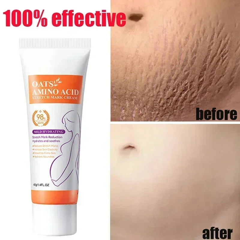 Stretch Marks ครีมกําจัดถาวร กําจัด Body Belly Stretch Marks เครื่องหมายบวม ลบรอยแตกของผิว Repair Firming Care