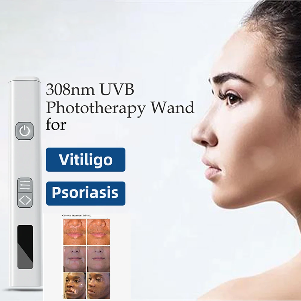 

Mini 308nm 12/33/39MW UV Light Therapy Device for Spot Vitiligo and Psori-asis Treatment Handheld Medical Device Home Nursing