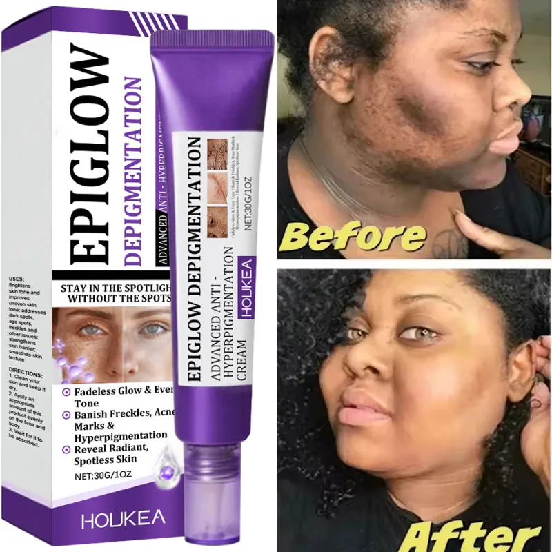 

Whitening Freckle Cream Melasma Dark Spots Pigmentation Removal Product Fade Stain Melanin Fast Repair Brighten Korean Skin Care