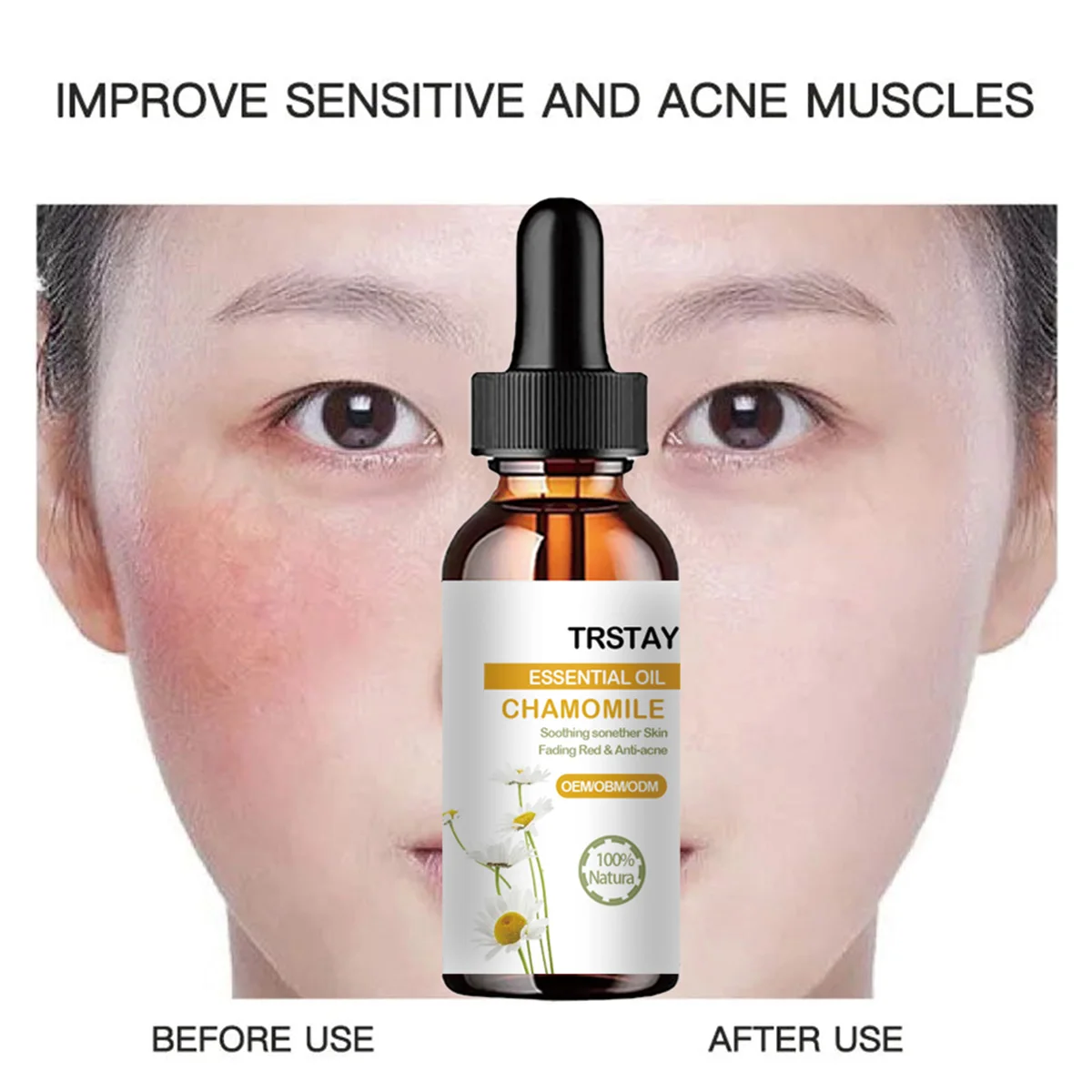 

Эфирное масло ромашки TRSTAY для кожи, успокаивающее уменьшение покраснений и лечение шрамов от прыщей, эссенция для лица для мам и детей