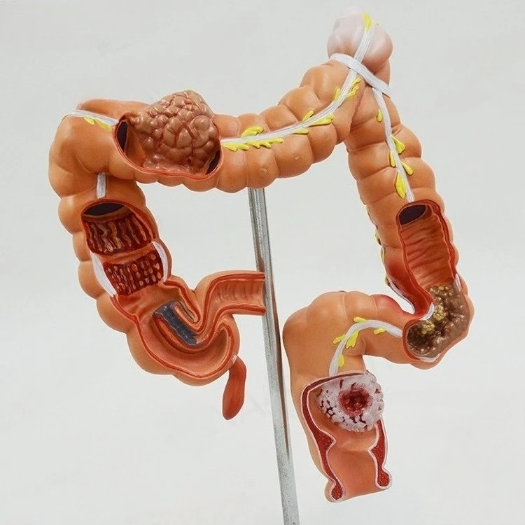 Human colon disease model, anorectal department, digestive department, large intestine model