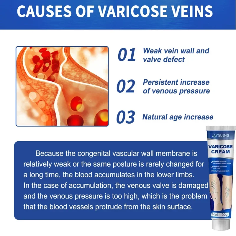 Laser Pen Lampshade Tool Varicose Veins Cream Remove Red Blood Streak Varicocele Vasculitis Phlebitis Strengthen Capillary