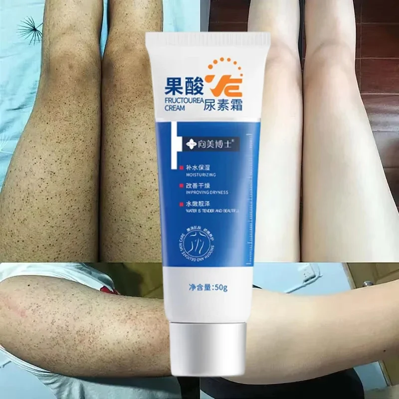 Curing Keratosis Pilaris Chicken Follicle Skin Repair Cream Body Dark Spot Remove Whitening Smooth Moisturize Body Skin Care