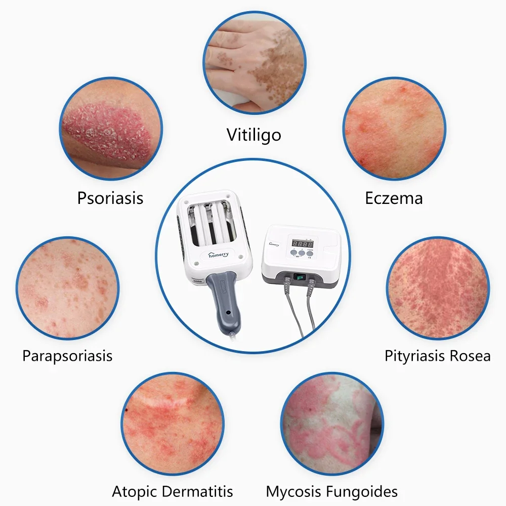 SIGMA 311nm UVB Targeted Phototherapy Wand SH2B UV Lamp for Vitiligo Psoriasis Eczema Treatment UV Light Device