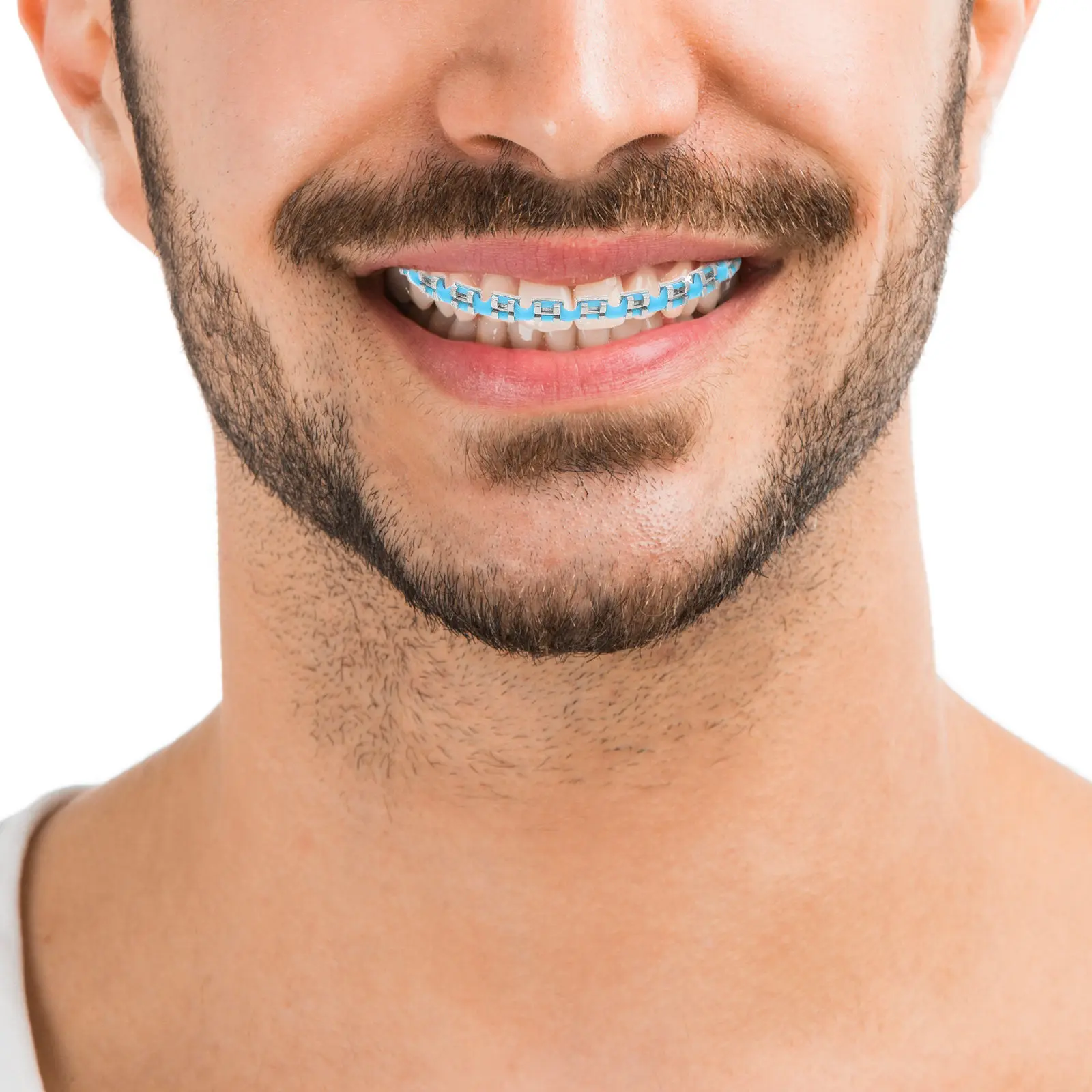 2Pcs Dental Decorations Braces Ornament Fashionable Comfortable Fit Easy Install Removable Portable Teeth Ligature Ties