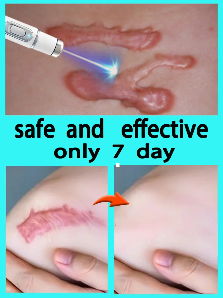 

Keloid scar repair cream disappears