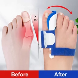 1 Pair Bunion Device Hallux Valgus Orthopedic Braces Toe Correction Night Foot Care Corrector Thumb Goodnight Daily Big Bone Ort