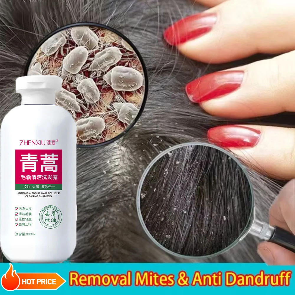 2 pcs Anti-Dandruff Shampoo Lice Mites Remover Shampoo Scalp Follicle Dissolve Oil Antipruritic Anti Hair Loss Treatment