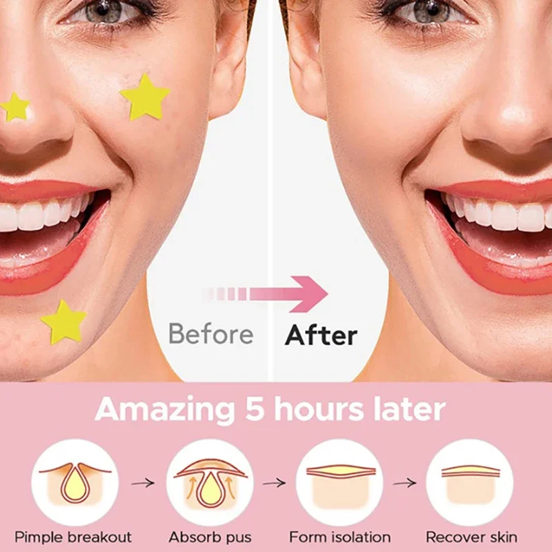 360 Uds corazón estrella cara cuidado de la piel acné parche para espinillas curación profesional Invisible