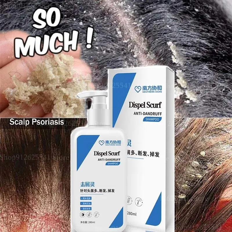 280ml Anti-dandruff Shampoo for Oil Control Refreshing Dandruff Head Itching Acne Head Mite Hair Loss Hair Shampoo Treatment