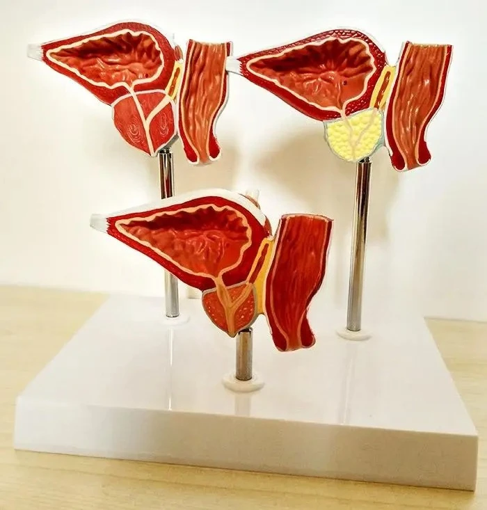 Prostate pathology teaching model Prostate lesions anatomy education teaching model