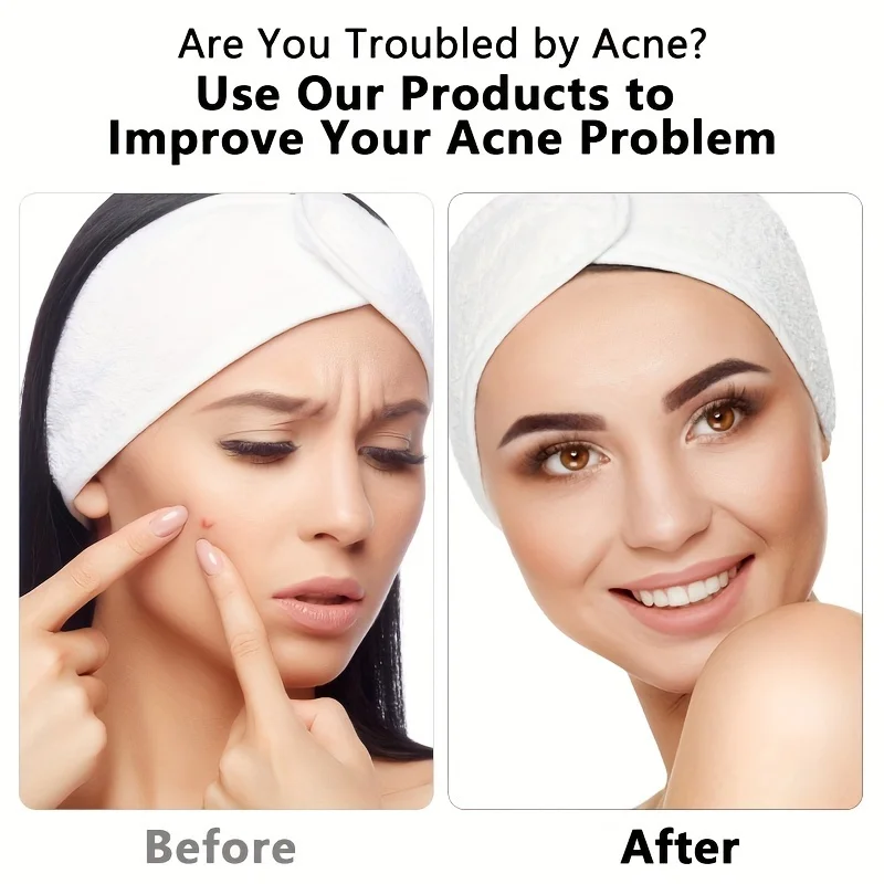 6 قطع من مشابك الخلايا المصنوعة من الفولاذ المقاوم للصدأ لإزالة الرؤوس السوداء وحب الشباب واللحية القصيرة، مناسبة لجميع أنواع البشرة.