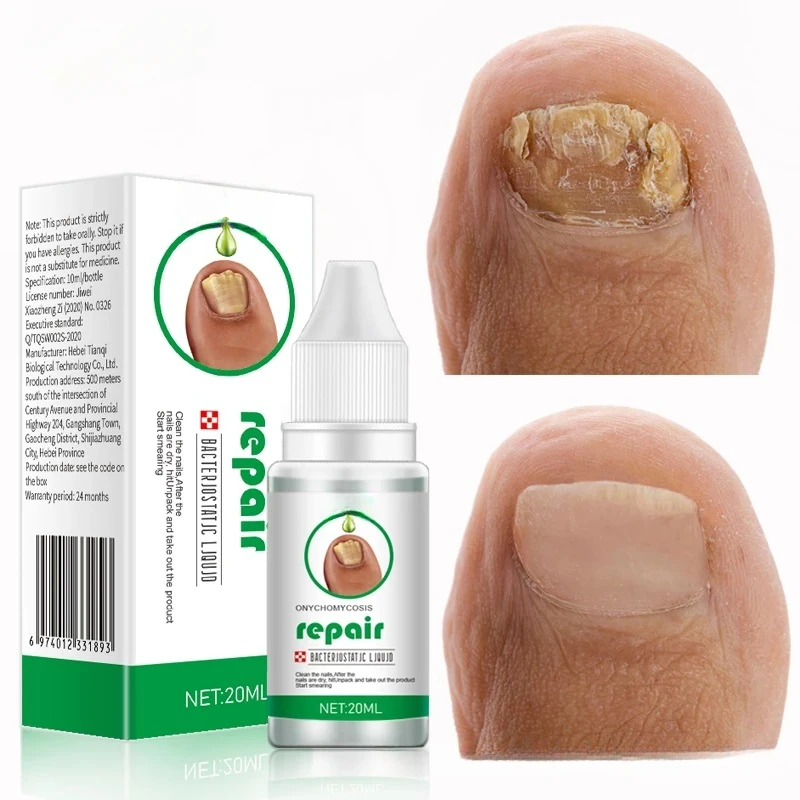 

Nail Fungus Treatment 20ml Nails Repair Essence Liquid Renew Damaged Broken Cracked & Discolored Nails for Damaged Nail