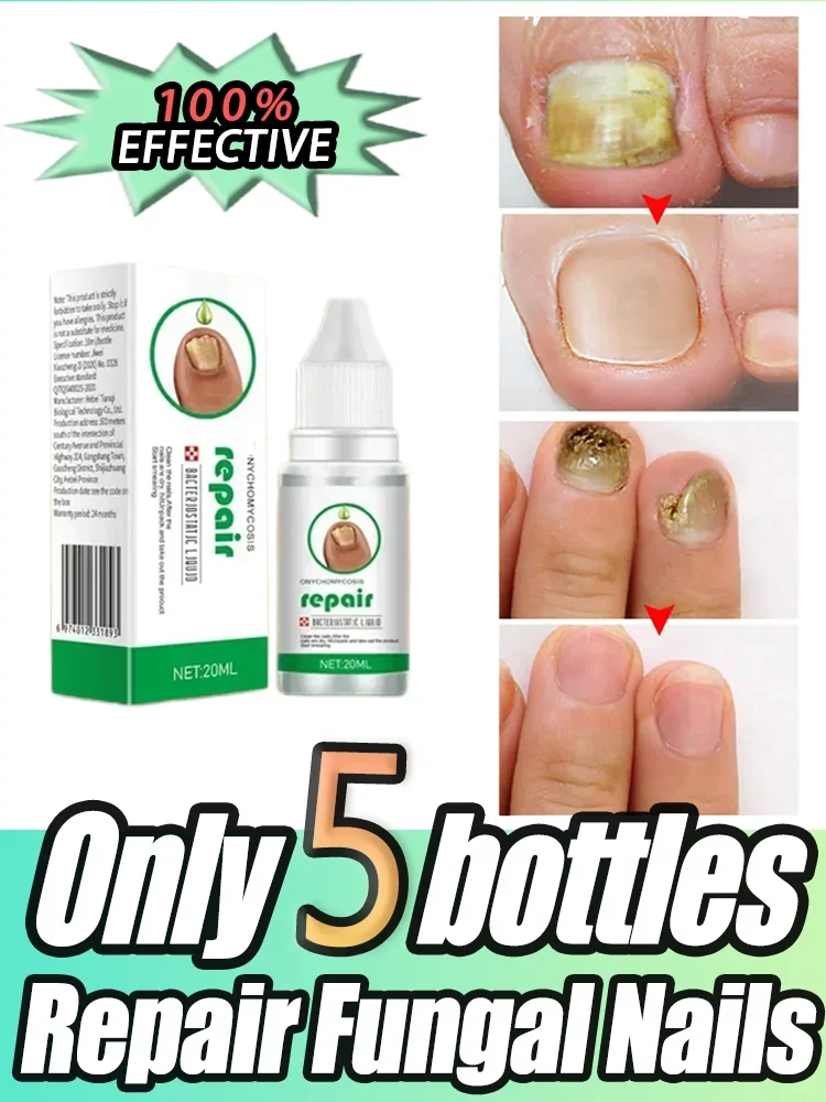 Fungal Nail Treatment Oil Foot Repair Essence Toe Nail Fungus Removal Gel Anti Infection Cream Fungal Nail Removal