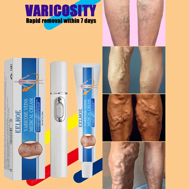 High Tech Laser Therapy Effective Relief Of Dilated Vasculitis In The Legs Phlebitis Health Improved Circulation New Product