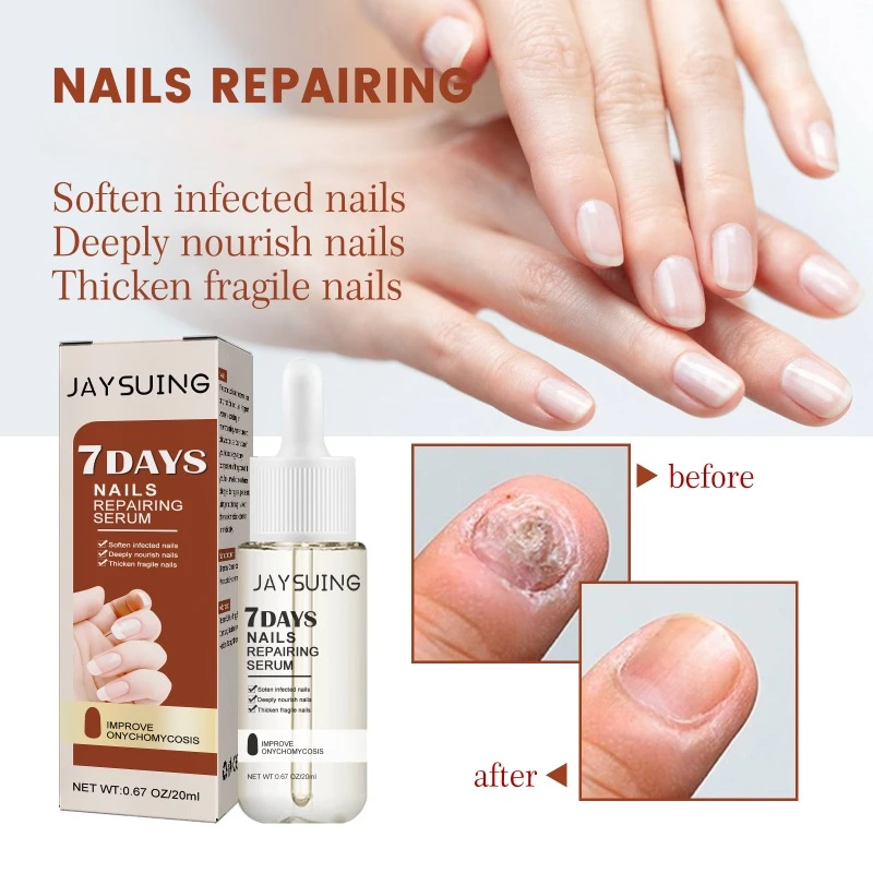 Fast Fungal Nail Treatments Serum Onychomycosis Ingrown Toenails Paronychia Anti-infective Fungus Foot Repair Essences Care