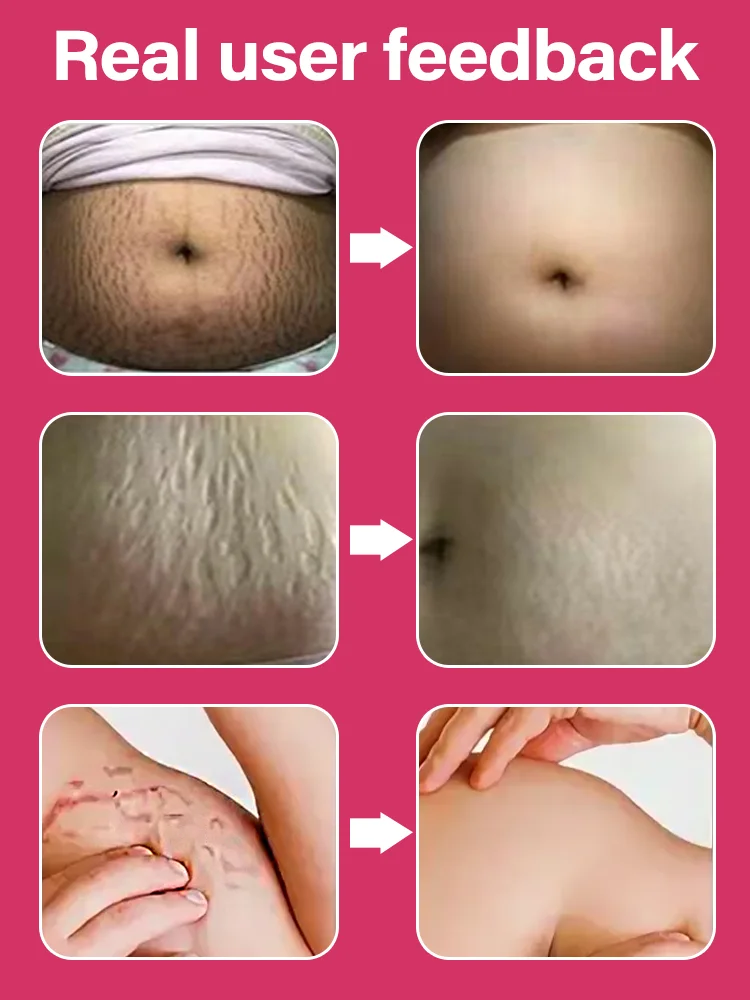 Essential oil line: restore the skin of the stomach, thighs, chest