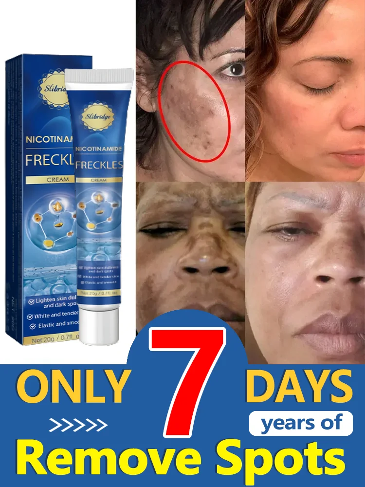 

Freckles Removal Cream Dark Spot Remover for Face Melasma