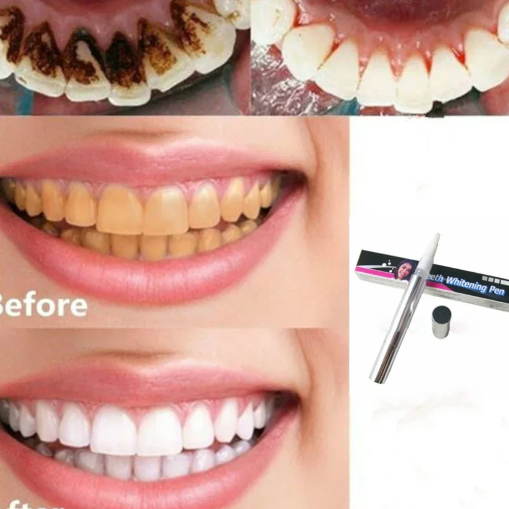 Hot Tooth Whitening Gel Pen Bleach Yellow or Remove Dental Plaque Oral Hygiene Cleaning Care Tool Is Mild and Non Irritating