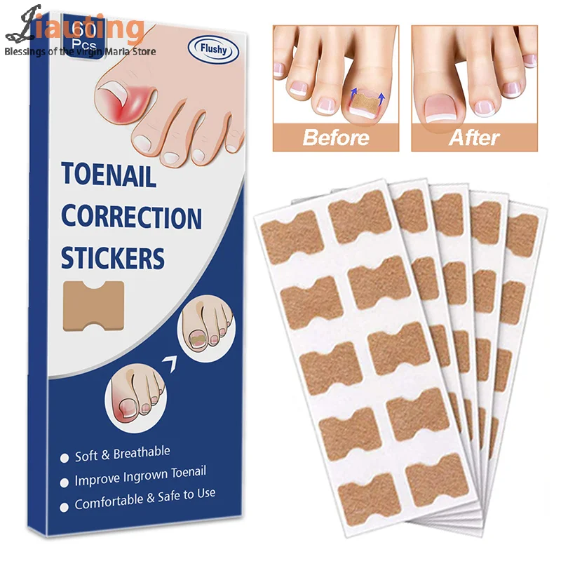 Ingrown Correção de Unhas Adesivos, Unha Corretor Patches, Tratamento Paroníquia, Recuperar, Ferramenta Pedicure Care, 60Pcs