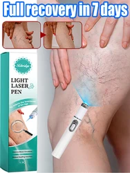 Blue Laser Heals Leg Veins