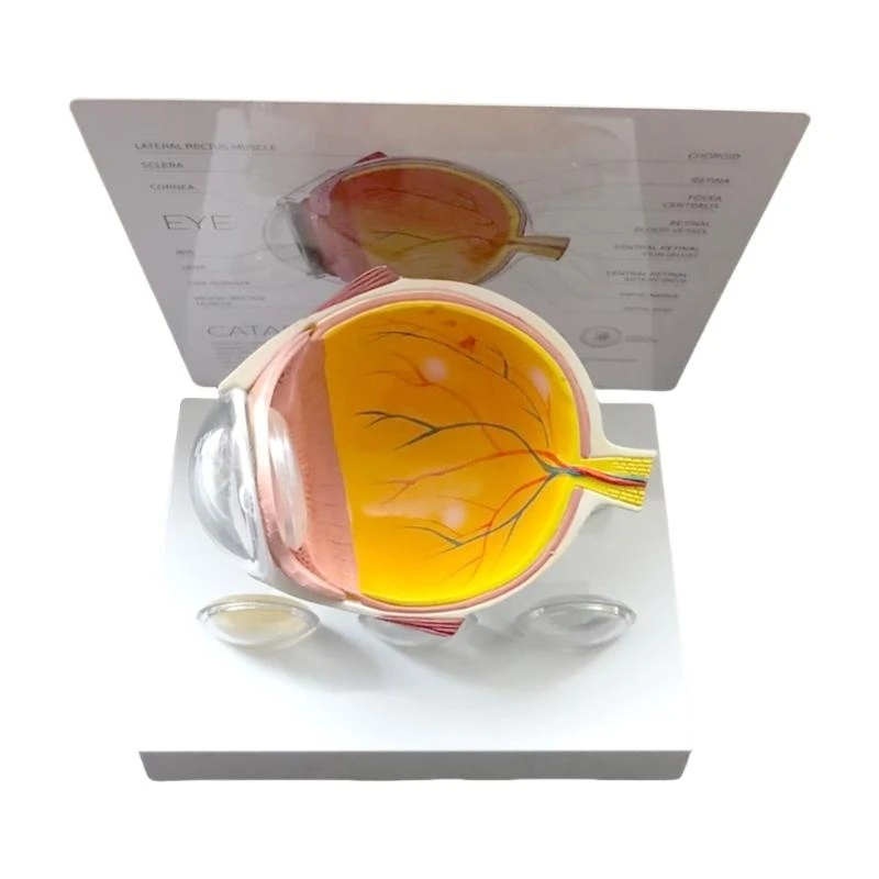 62KA نموذج تشريح مقلة العين المرضية الواقعية للتدريس، واستبحام الاستخدام التعليمي والعرض السريري