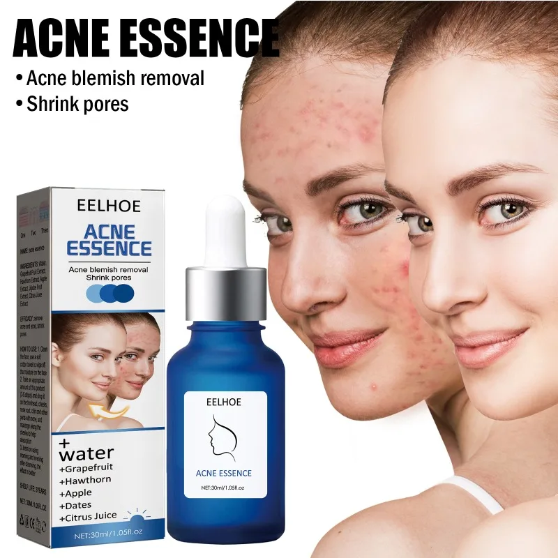 Anti-Acne Essence Fading Acne Marks Tightening Shrink Pores Mild Moisturizing Repairing Acne Treatment Facial Serum Skin Care