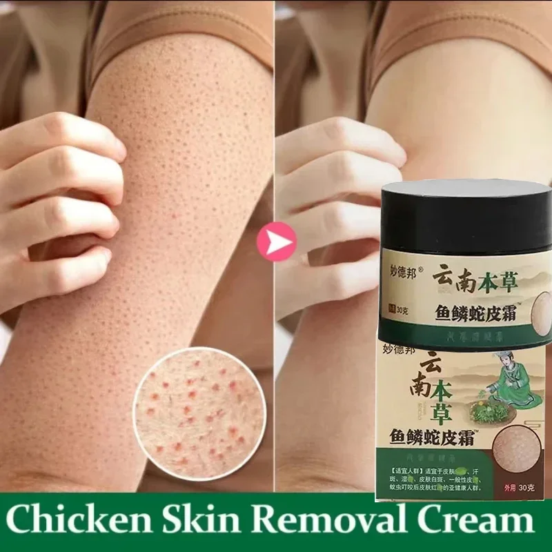 Chicken Skin Repair Cream Curing Keratosis Follicle Pilaris Body Dark Spot Remove Thick Pores Moisturizing Smooth Essence