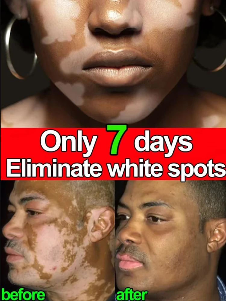 yy Vitiligo Cream Natural Relief Skin Treatment Soothing White Spot Removal Vitiligo Cream Eliminate Pigment White Spot  Removal