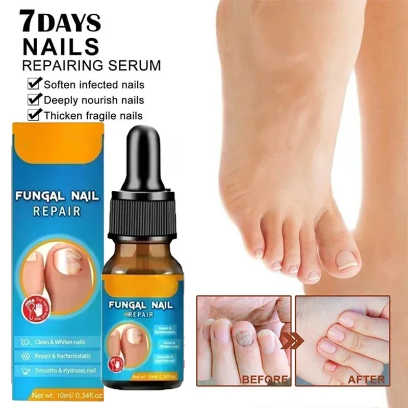 

Nail Fungal Treatment Serum Anti Infection Paronychia Onychomycosis Removal Toe Fungus Hand Foot Repair Gel Care Serum