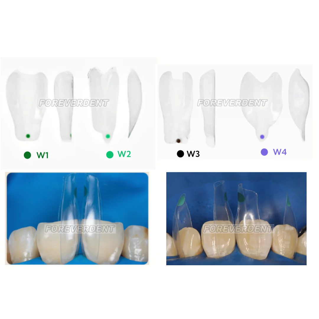 

Dental Widening Anterior Tranparent Clear Matrix BT Matrices Black Triangle Wedges Diastema Fits BioClear W1/W2/W3/W4