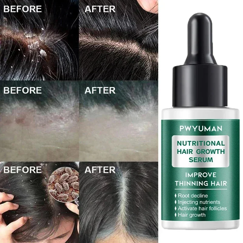 علاج فروة الرأس جوهر رذاذ القشرة الحكة السيطرة على النفط مكافحة فقدان فروة الرأس تنظيف إصلاح مصل منتجات العناية بالشعر الجمال