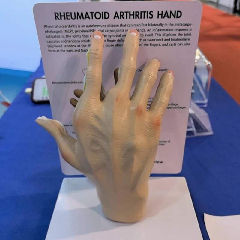 Modelo De Mão De Osteoartrite, Réplica De Anatomia Humana E Fisiologia, Modelo De Anatomia Do Escritório