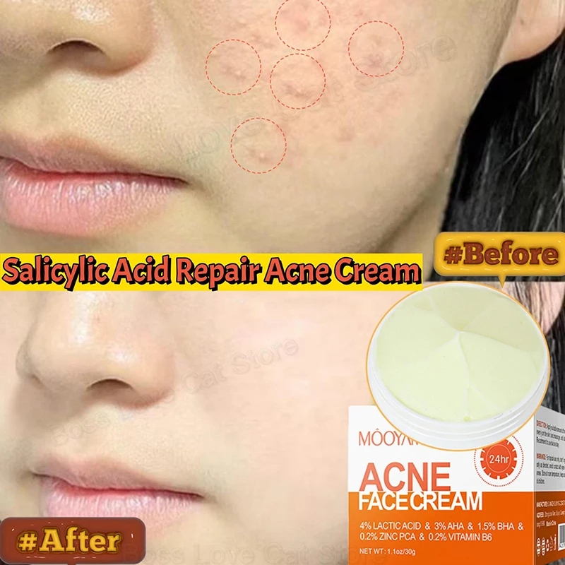 

Salicylic Acid Acne Face Cream Eliminate Acne Close Mouth lmprove Blackhead Pores Condition Repair Acne-prone Skin Oil Control