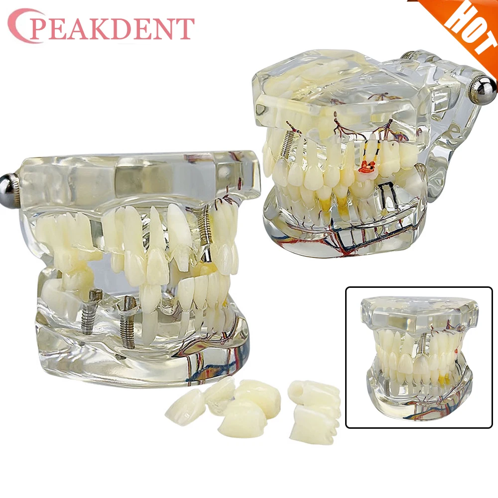 

Стоматологические модели для лечения нейронных зубов, модели из смолы с заболеваниями зубов для преподавания и исследований в медицине и стоматологических заболеваний ﻿