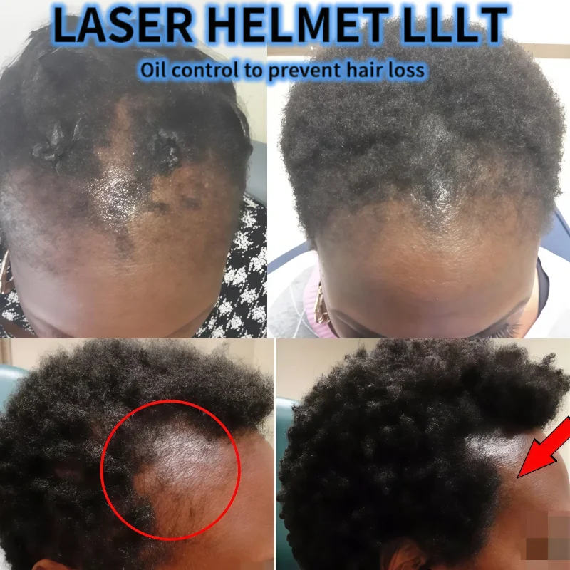 

Медицинская 650 нм лазерная шапочка для роста волос, низкочастотная LLLT для лечения хронического выпадения волос