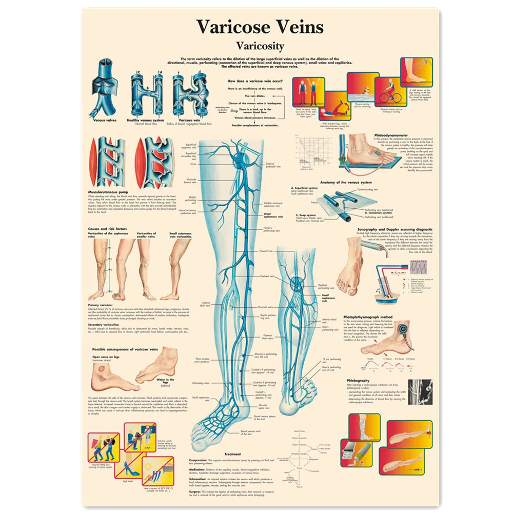 Varicose Veins Posters and Prints Vintage Human Anatomy Wall Art Painting Wall Chart Hospital Clinic Room Home Decor Sticker