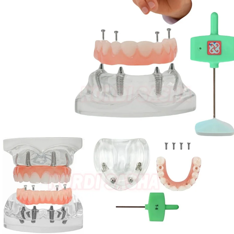 1Pcs/Box Transparent Upper/Lower Jaw Type Dental  Implant Teeth Model All on 4 Overdenture Modle With 4 Removable Screws