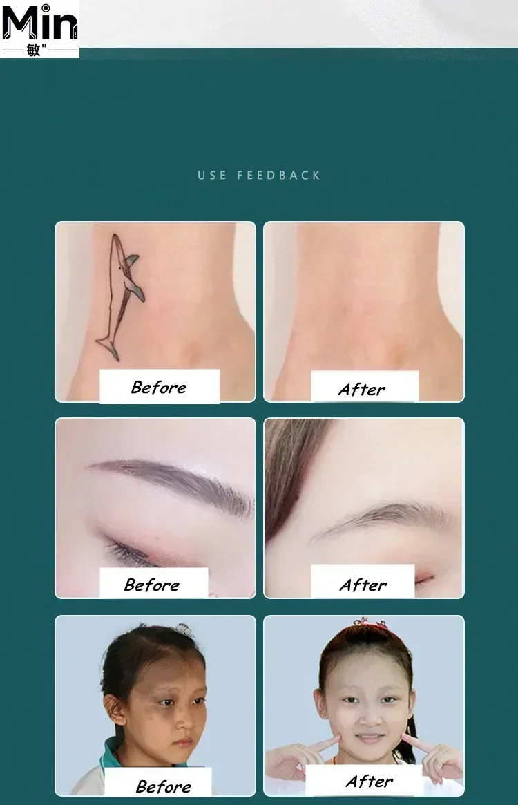 

1064nm Eyebrow Tattoo Freckle Pigment Removal Black Doll Whitening