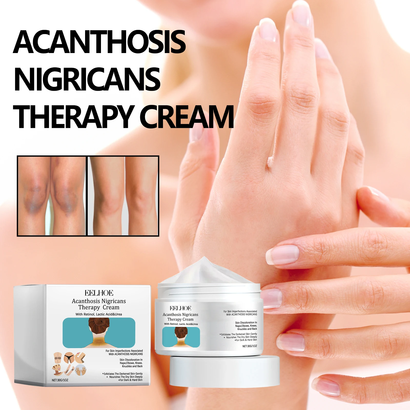 Acanthosis Nigricans Therapy Cream Elbow Joint Body Moisturizer Acanthosis Nigricans Improvement Dark Skin Cream
